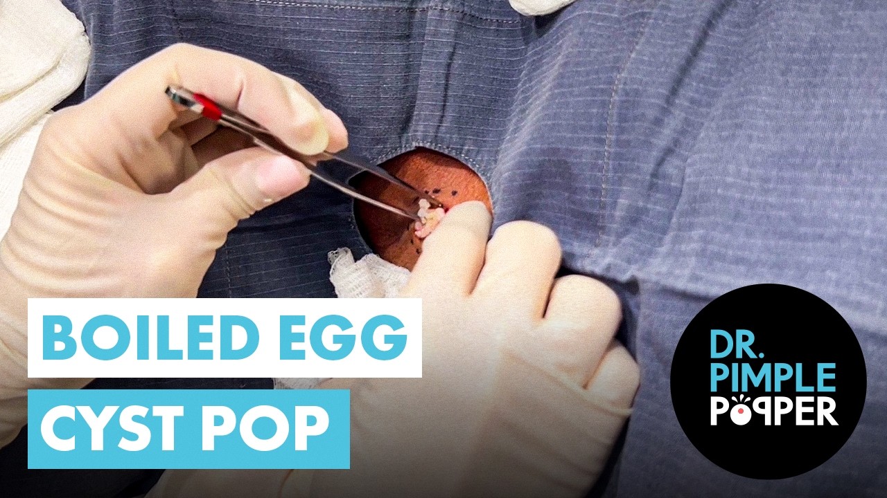 Boiled Egg Cyst Pop