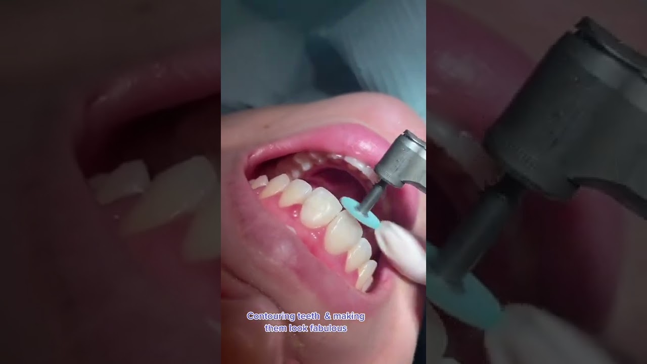 This is how we do it 🦷 #bonding #composite #teeth #dentist #dentistry #contouring #teethwhitening