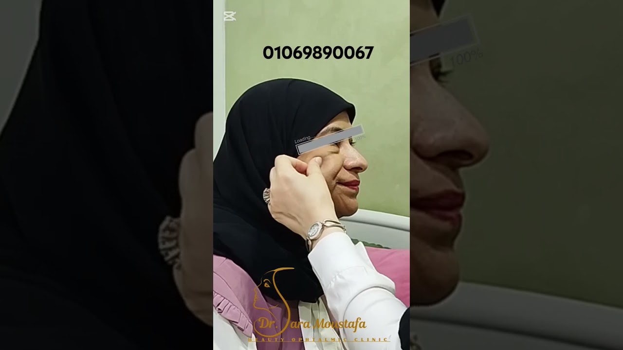 trifecta with midface lift with Dr.sara Moustafa Afify