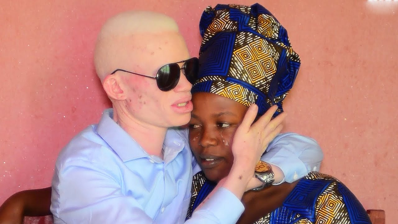 Albino's Love Story shocked the world : THIS VIDEO WILL MAKE YOU CRY