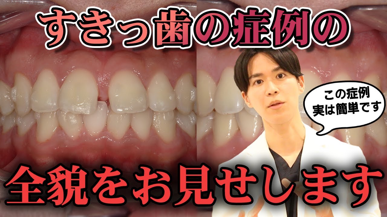 【すきっ歯の方必見】すきっ歯の矯正の全貌を全てお見せします！！