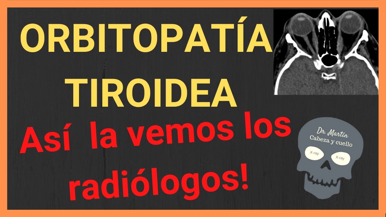 ORBITOPATÍA TIROIDEA 👀[Hallazgos radiológicos]