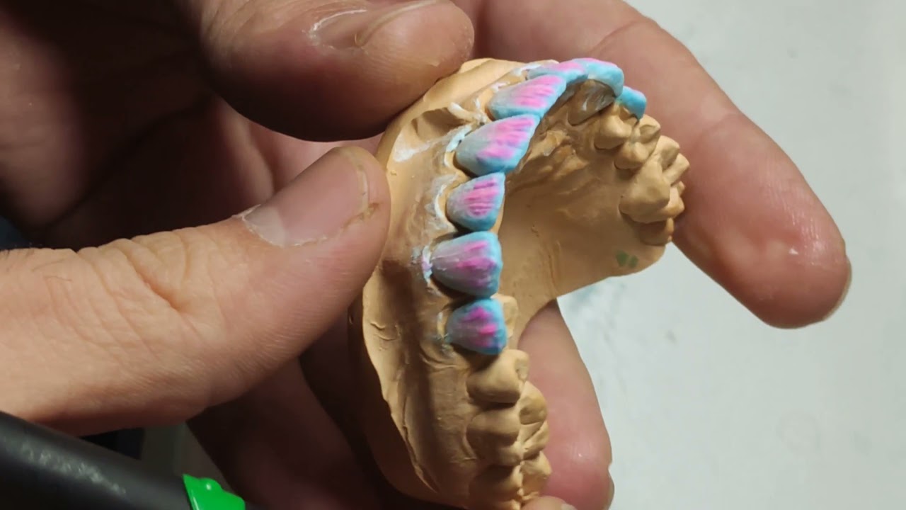 بناء الأسنان الأمامية _ceramic layers