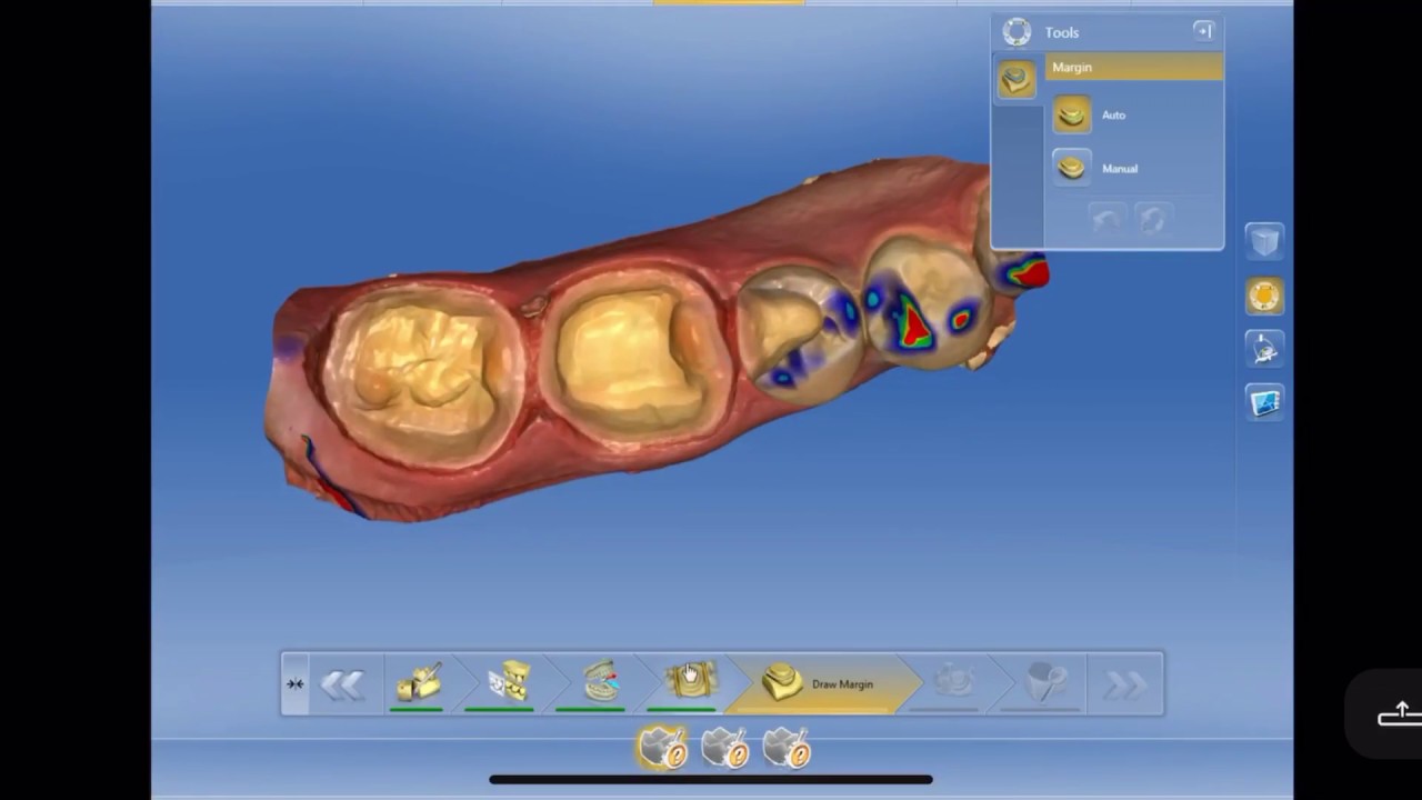 CEREC: Коронки 30/31, вкладка 29.