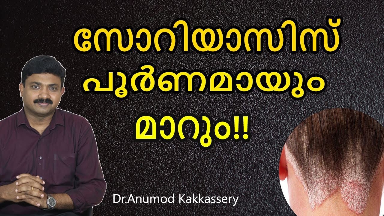 Psoriasis Ayurveda treatment Malayalam| സോറിയാസിസ് യഥാർത്ഥ കാരണങ്ങളും ആഹാര ശൈലികളും| Dr Anumod