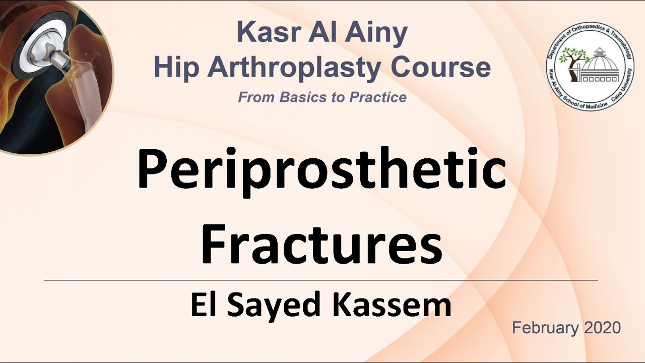 5 1 Periprosthetic Fractures   El Sayed Kassem