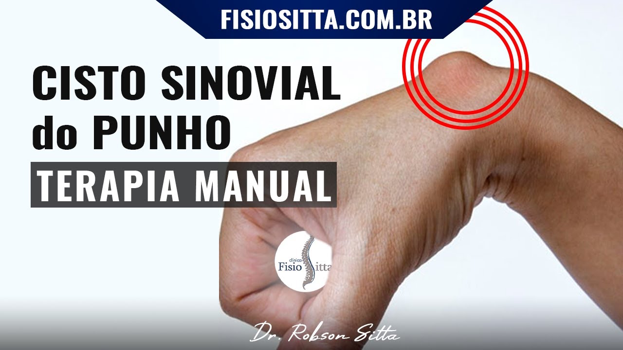 CISTO SINOVIAL MÃO PUNHO TERAPIA MANUAL EXERCÍCIOS MIOFASCIAL FISIOTERAPIA Clínica Dr. Robson Sitta