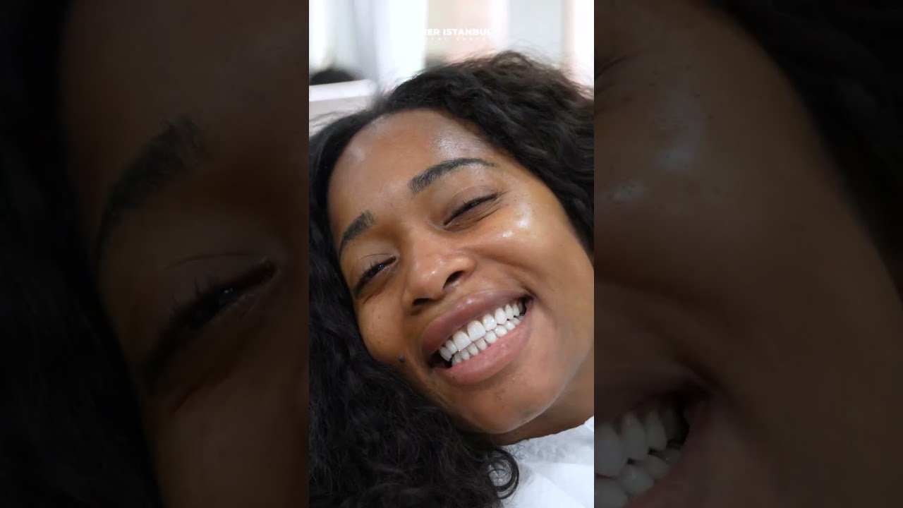 Smile Makeover with Laminate Veneers in Turkey | Before and After