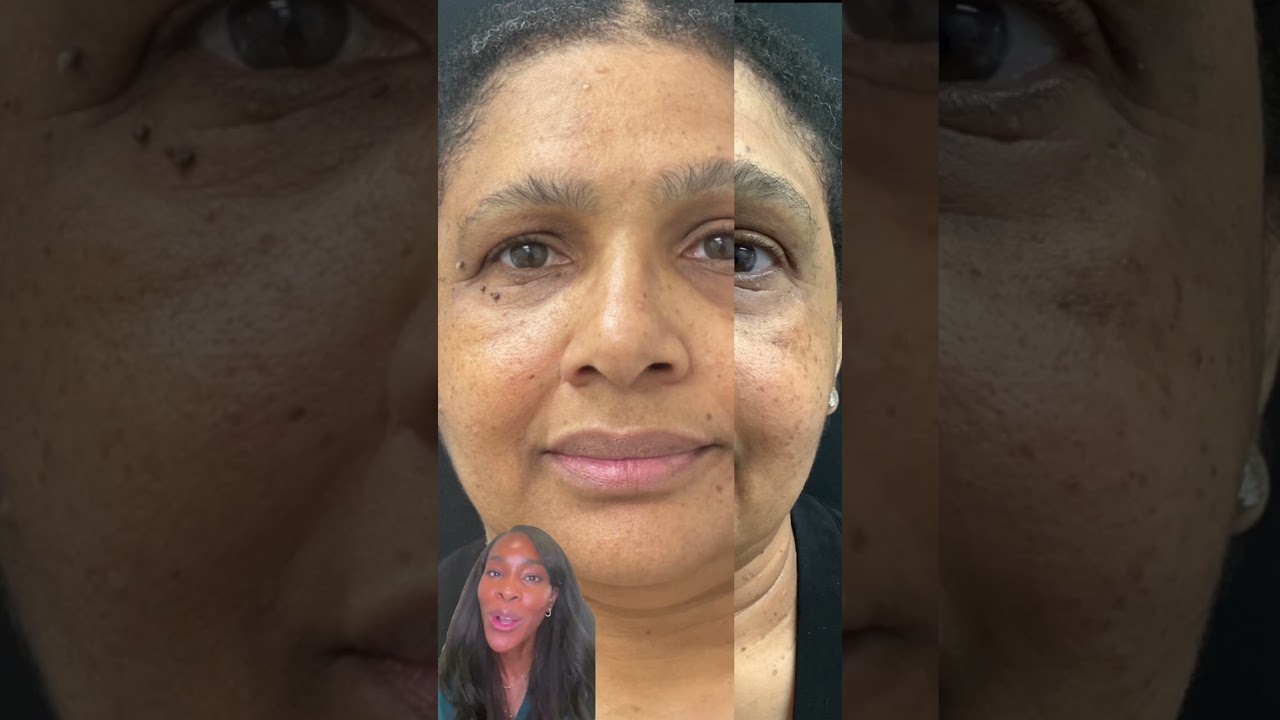 Brown growths on the face? Let's Discuss DPN's #shorts