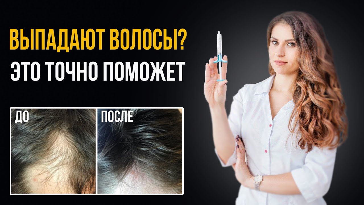 ВЫПАДЕНИЕ ВОЛОС что делать при АЛОПЕЦИИ. Лучшие методы лечения в Трихологии от облысения