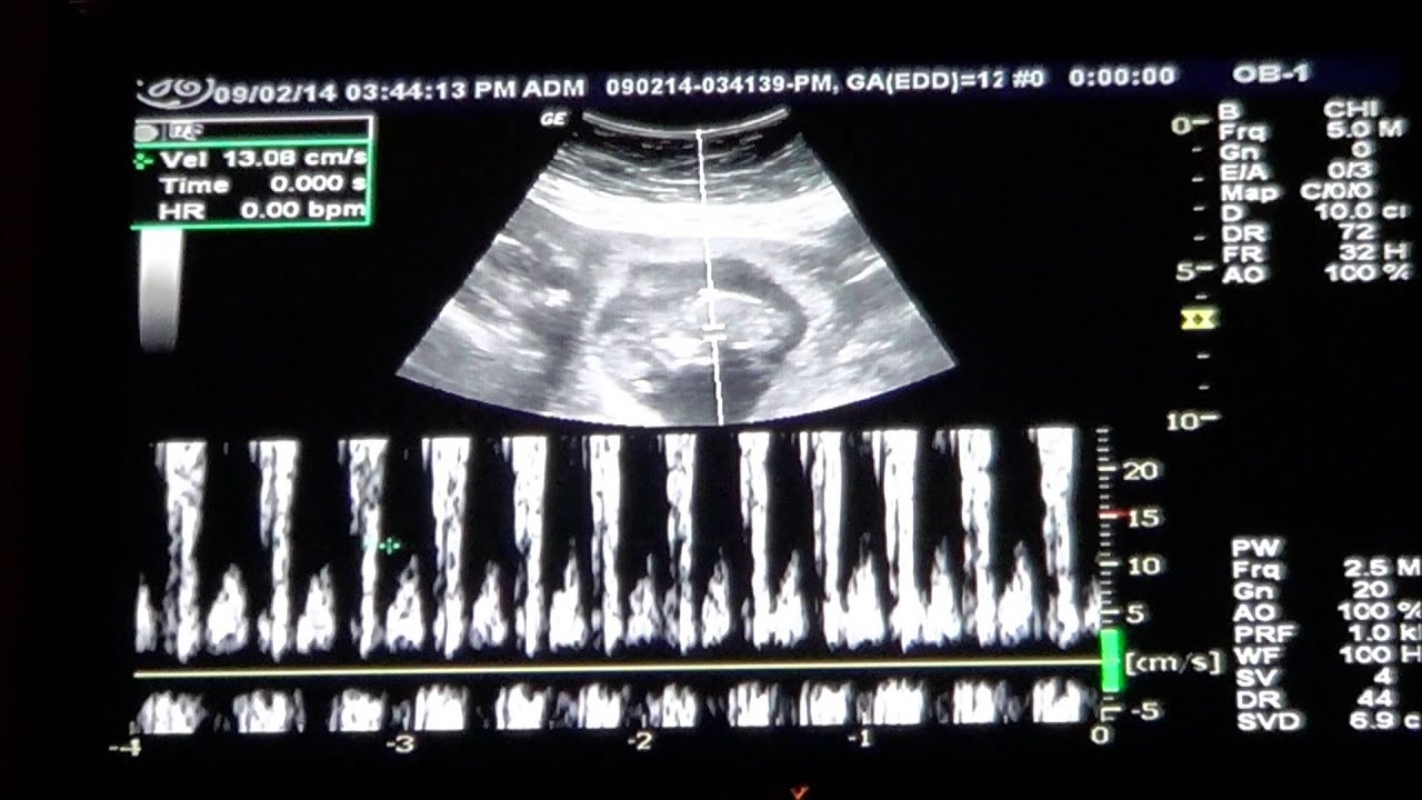 Baby 12 Week Ultrasound & Heartbeat