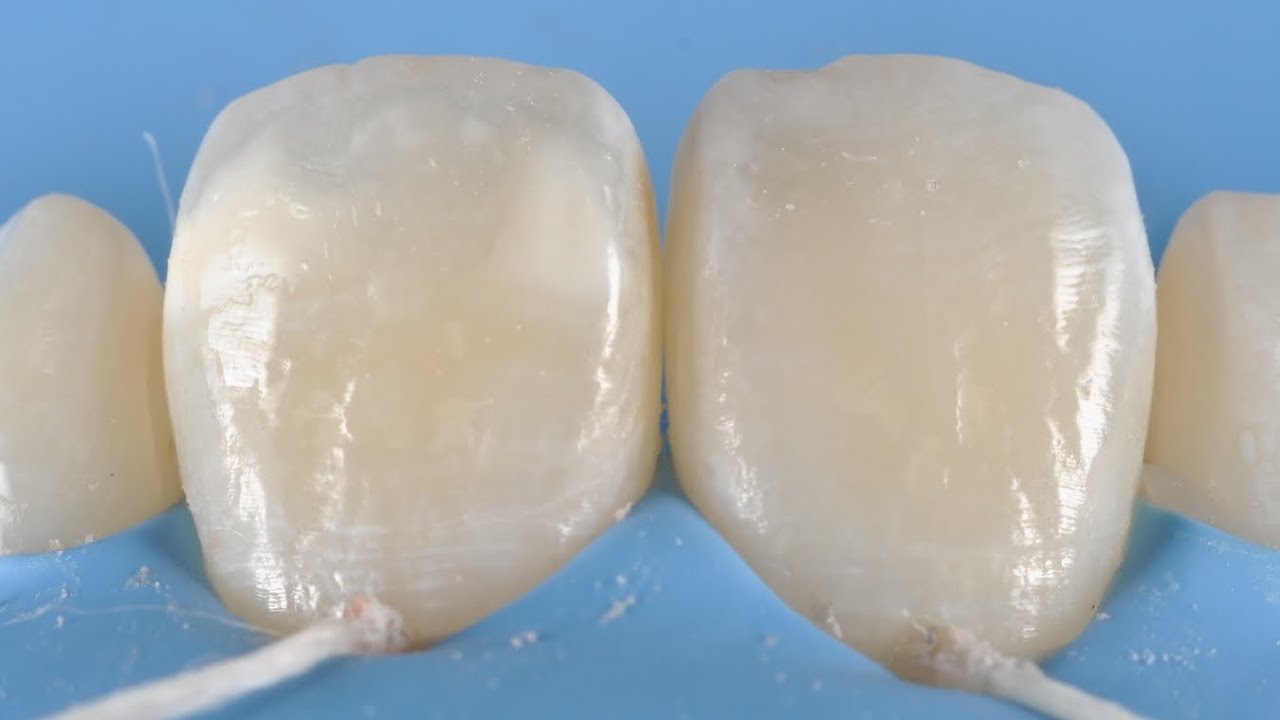 ICON (by DMG) Resin Infiltration for white lesion (non invasive treatment)