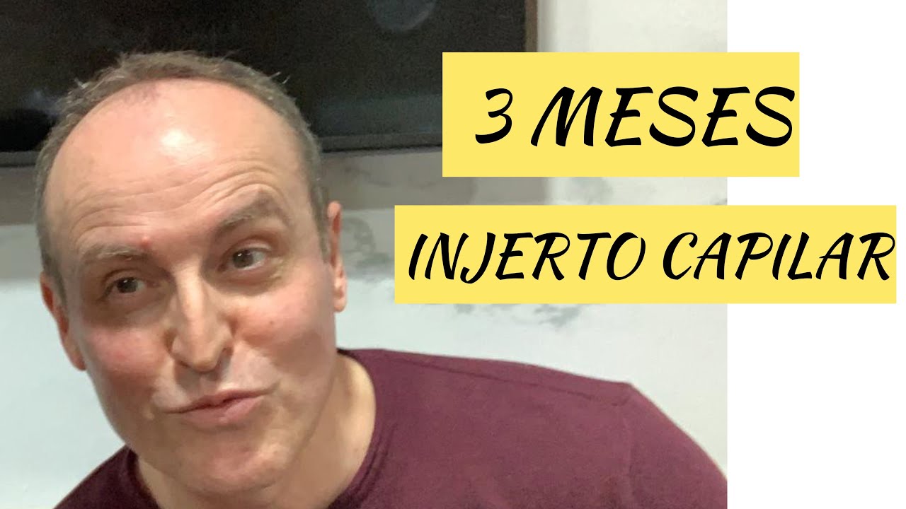 INJERTO CAPILAR 3 MESES