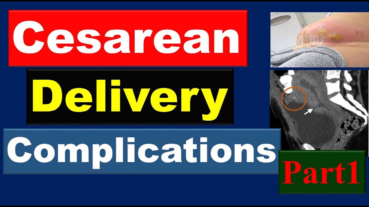 Cesarean Delivery Complications( Part1), Gynecologic Imaging
