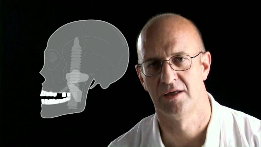 dr. Cesare Paoleschi: Impianti dentali pterigoidei