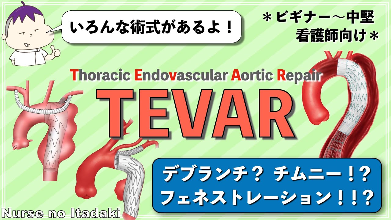 【TEVARの術式をマスターしよう！】デブランチ？チムニー？フェネストレーション？