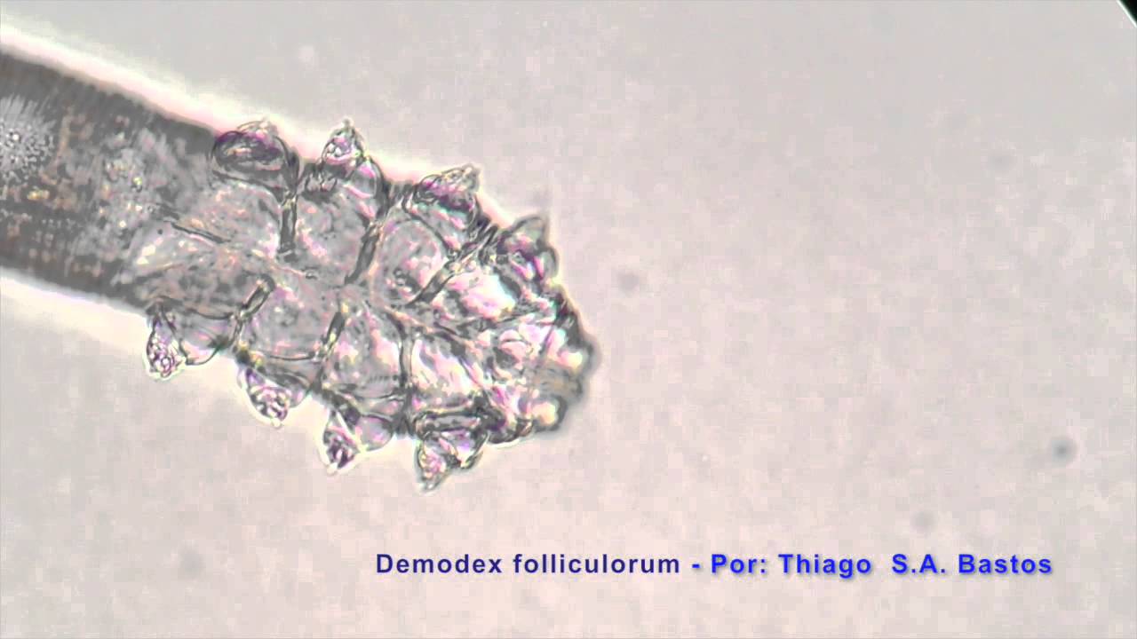 Demodex folliculorum (hominis) ♀
