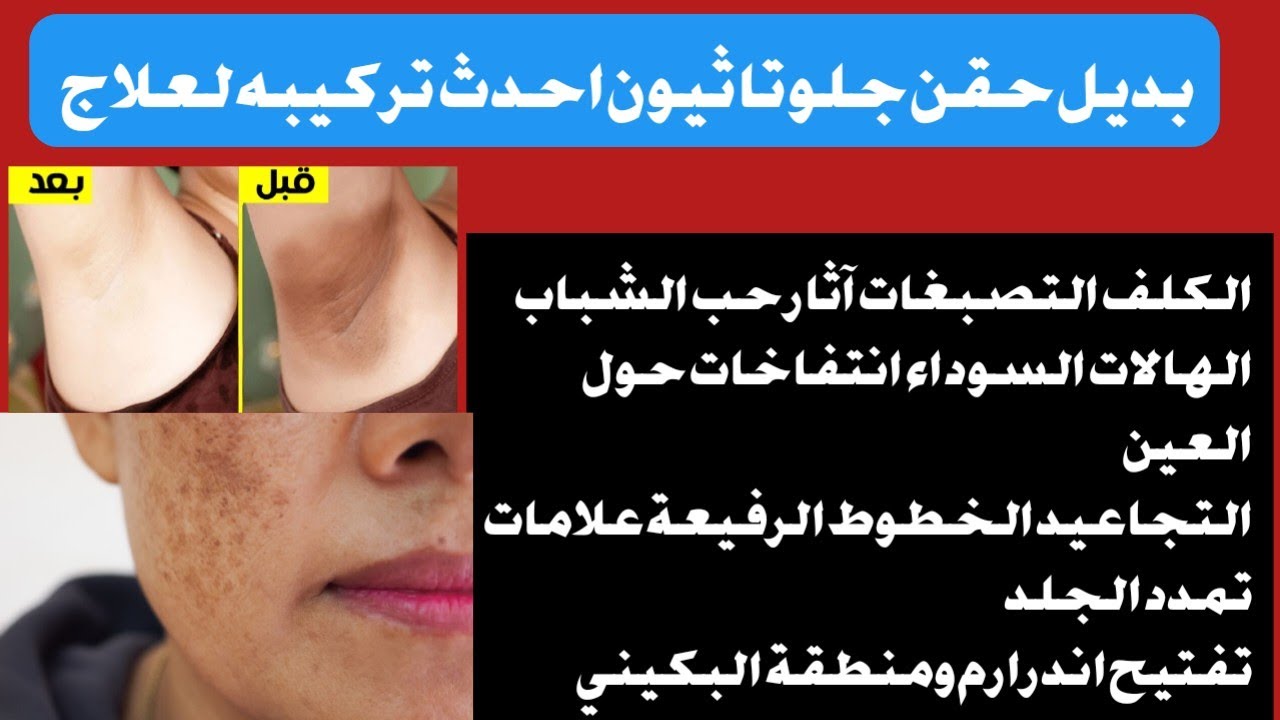 بديل حقن جلوتاثيون احدث تركيبه لعلاج التصبغات والكلف التجاعيد الهالات السوداء تفتيح اندرارم والبكينى