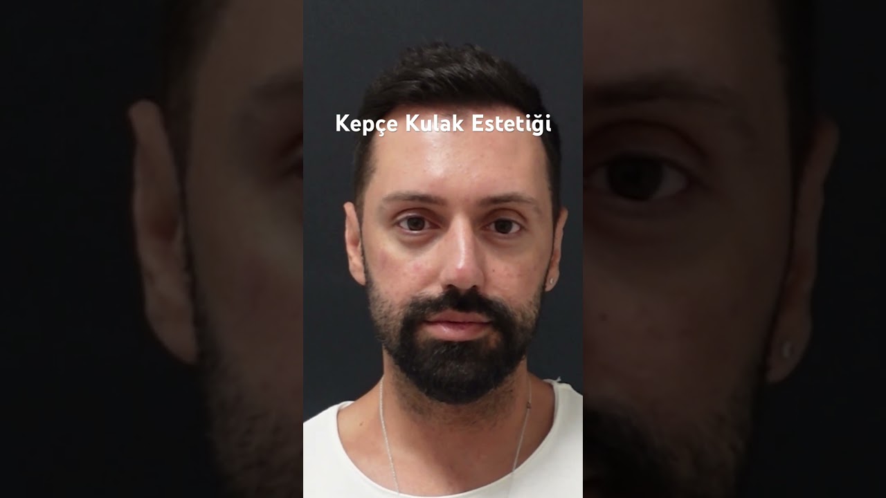 Otoplasty Before After (Ear Pinning) 