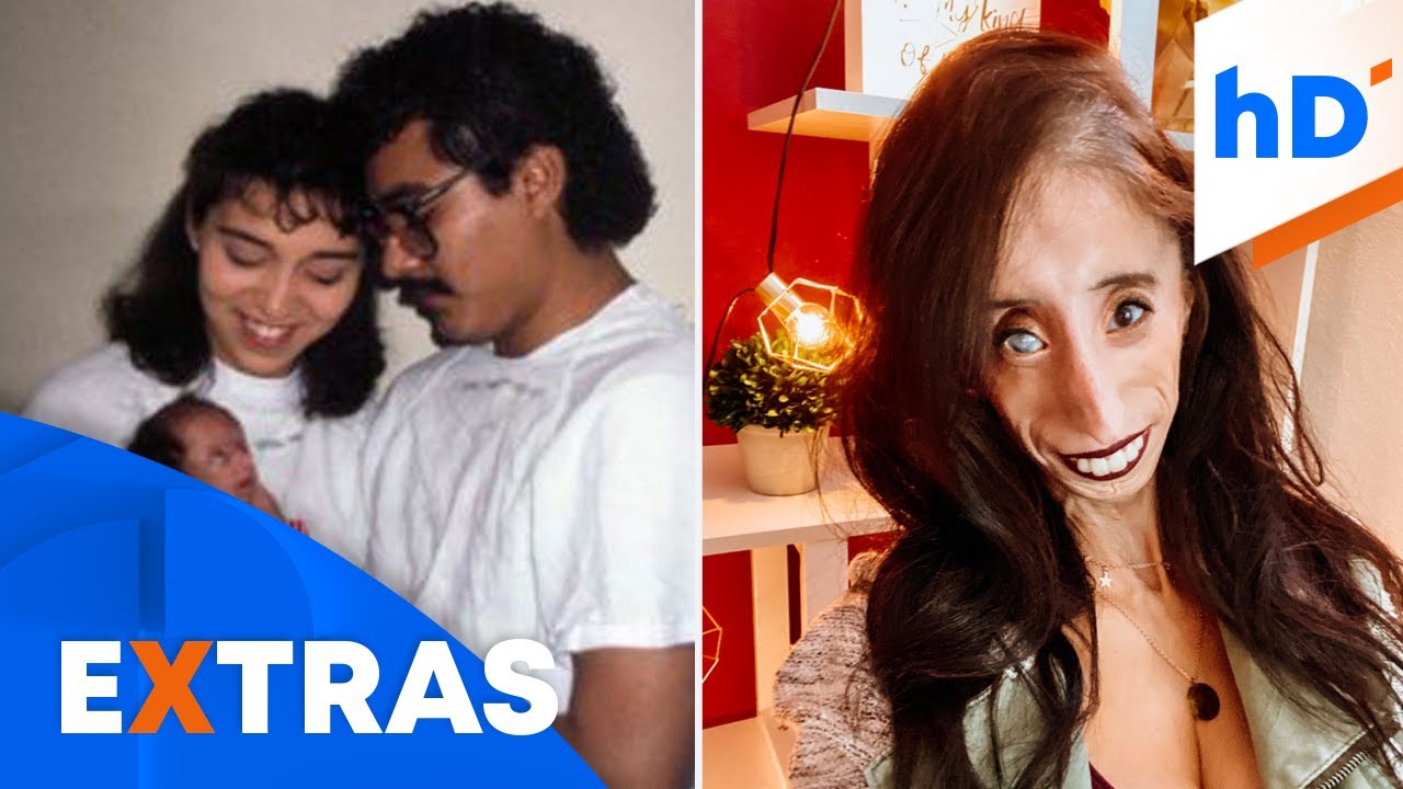 Lizzie Velásquez enfrentó ciberacoso por su enfermedad | hoyDía | Telemundo