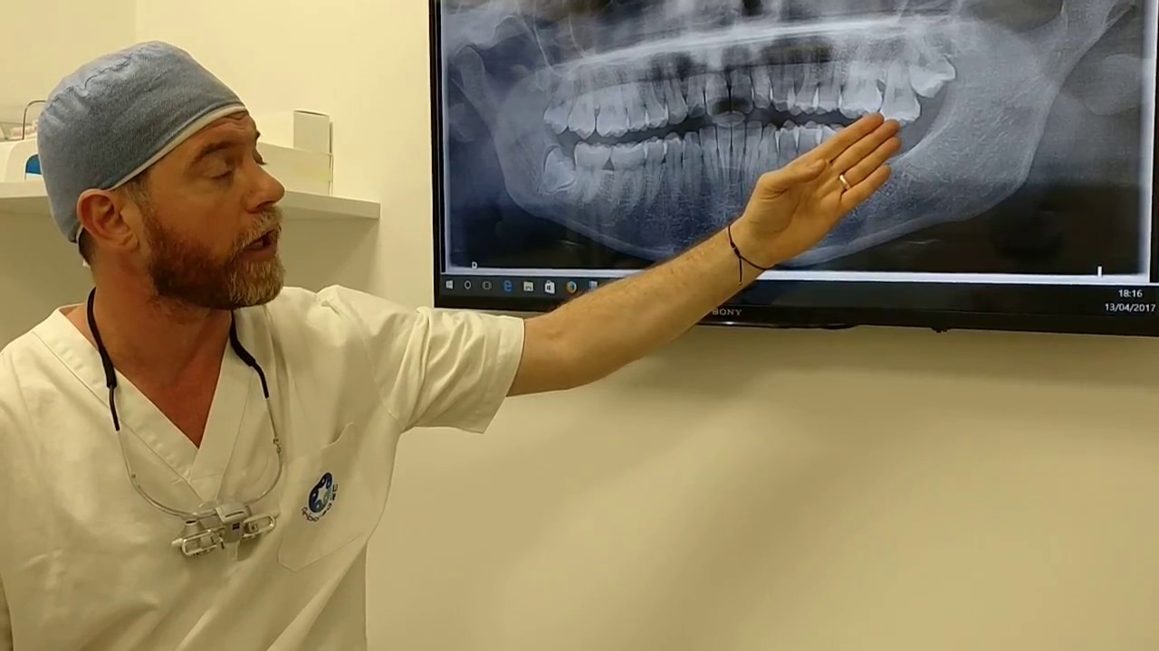 Estrazione del dente del giudizio - Arborea25