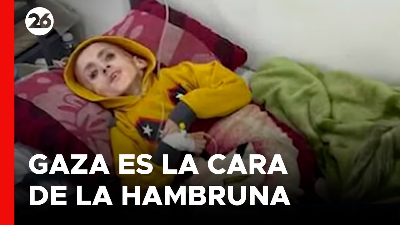 MORIR DE HAMBRE | La peor cara de la desnutrición en Gaza