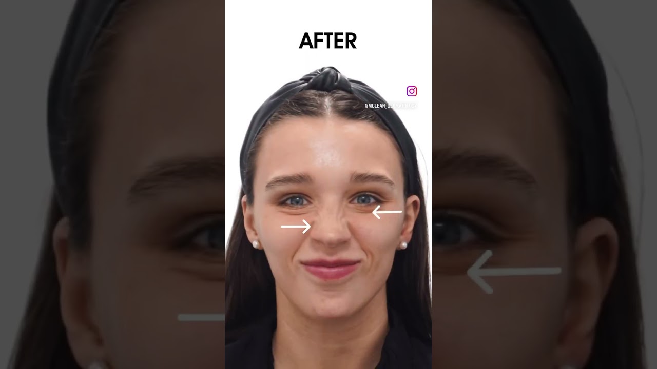 Botox Before + After #botoxtreatment #wrinklereduction #botox