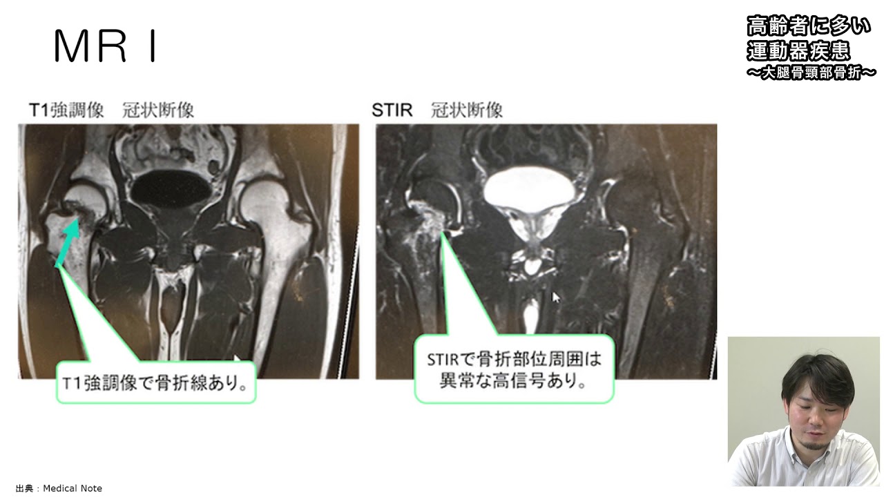 2 2高齢者に多い運動器疾患〜大腿骨頸部骨折〜