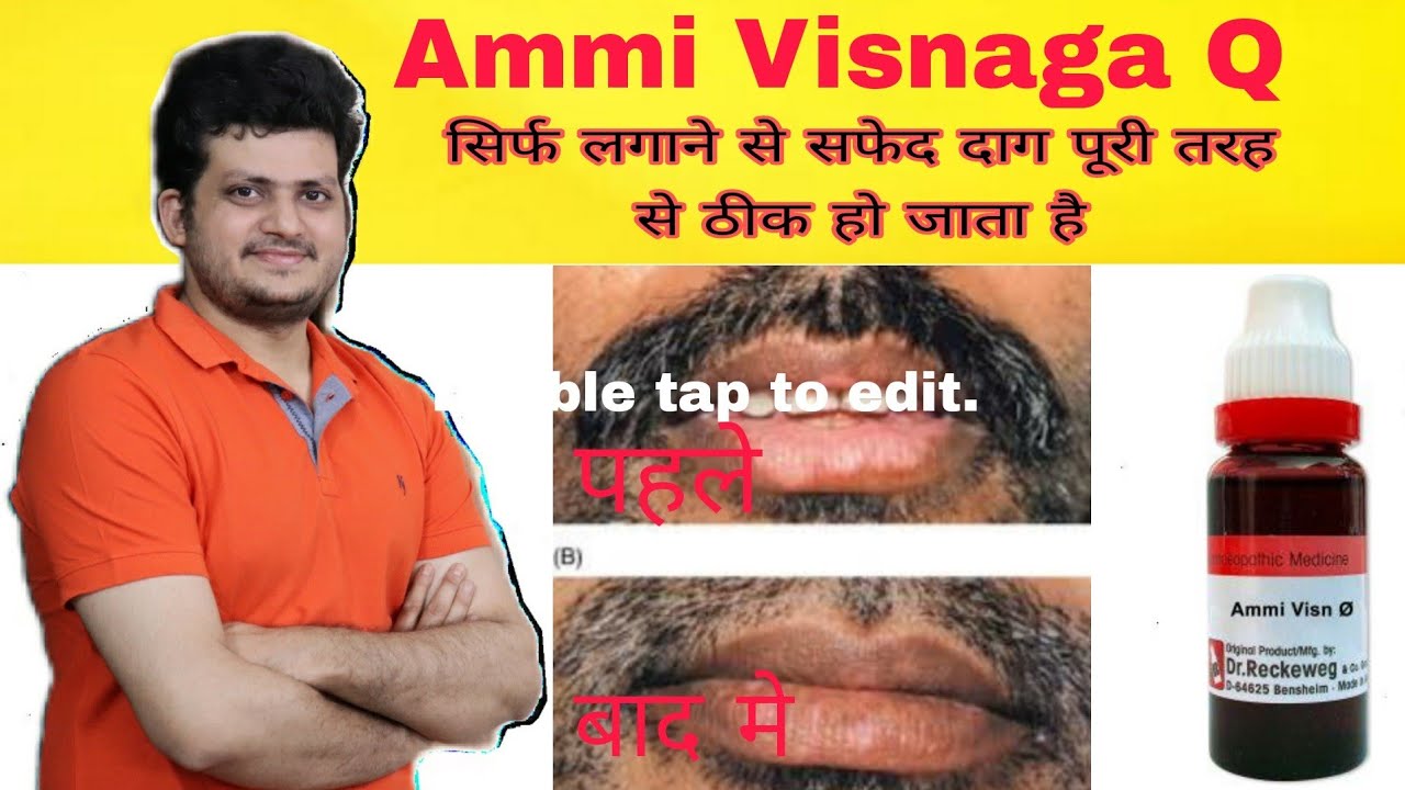 सफेद दाग को पूरी तरह से ठीक करें सिर्फ एक में होम्योपैथिक दवा लगाने से | New Effective Medicine |