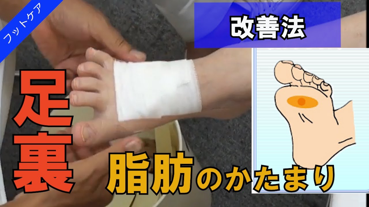 【改善法】足裏の脂肪腫