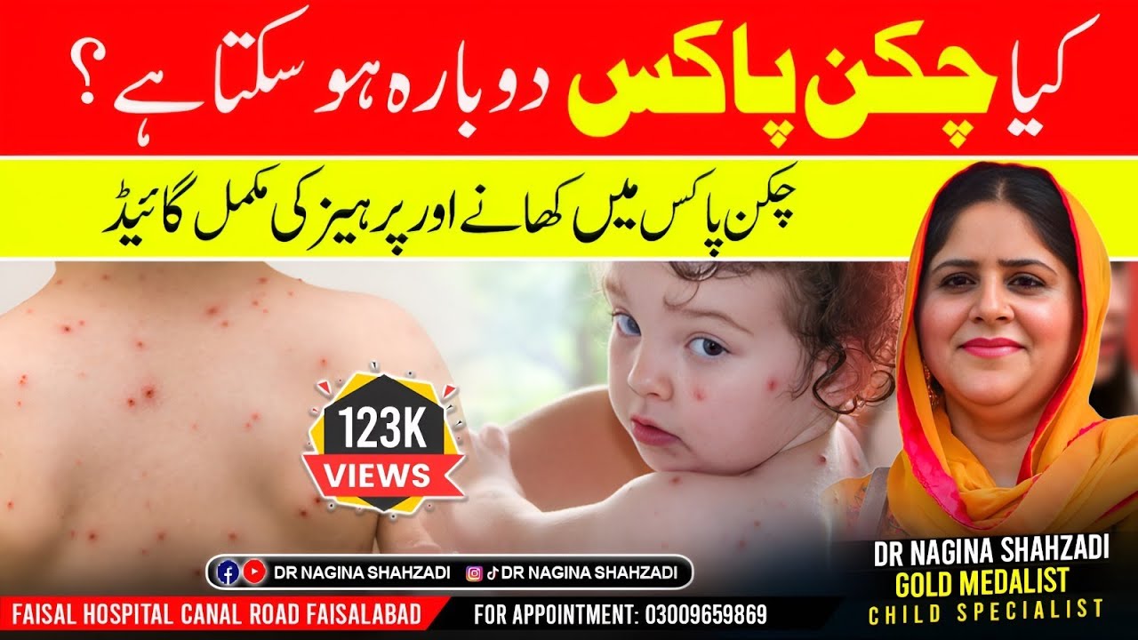 Diet in Chicken pox |kia chicken pox dobara ho skta hy|Urdu|Hindi |Dr Nagina Shahzadi