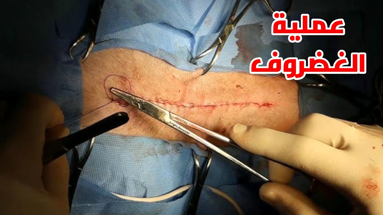 شاهد عملية ازالة الغضروف من الظهر بالجراحة والمنظار_ Lumbar disc removal surgery