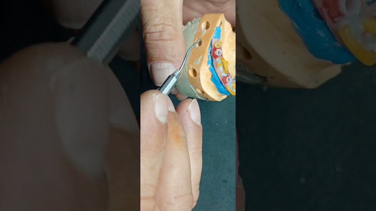 CONFECÇÃO DE BARRA EXTERNA PARA PRÓTESE PROTOCOLO