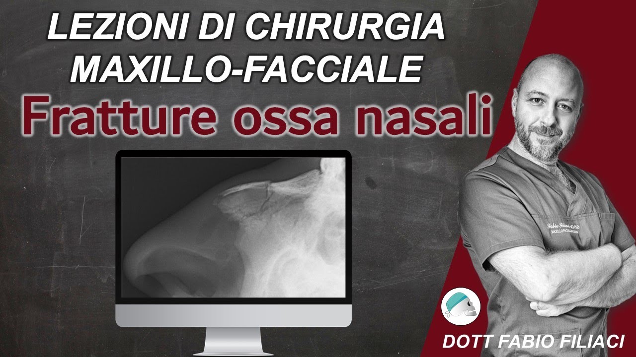 Lezioni di Chirurgia Maxillo facciale: Fratture delle ossa nasali