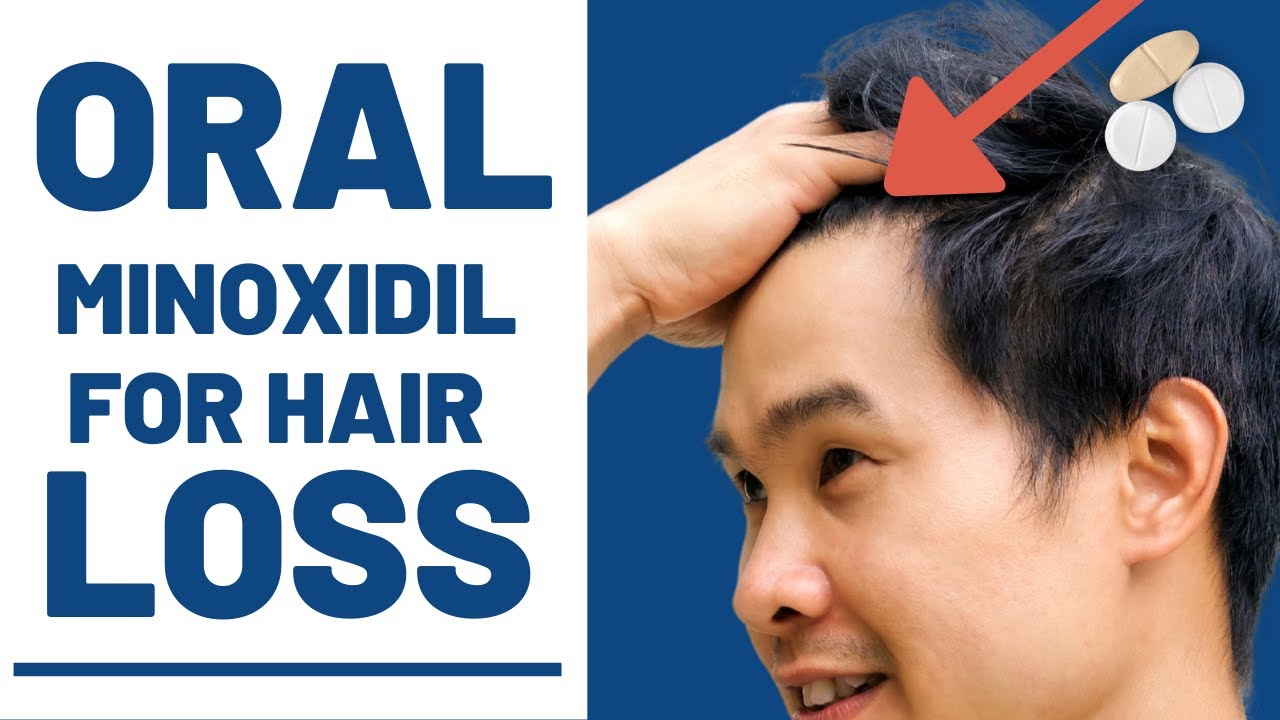 Oral Minoxidil for Hair Loss - How Effective Is it REALLY?