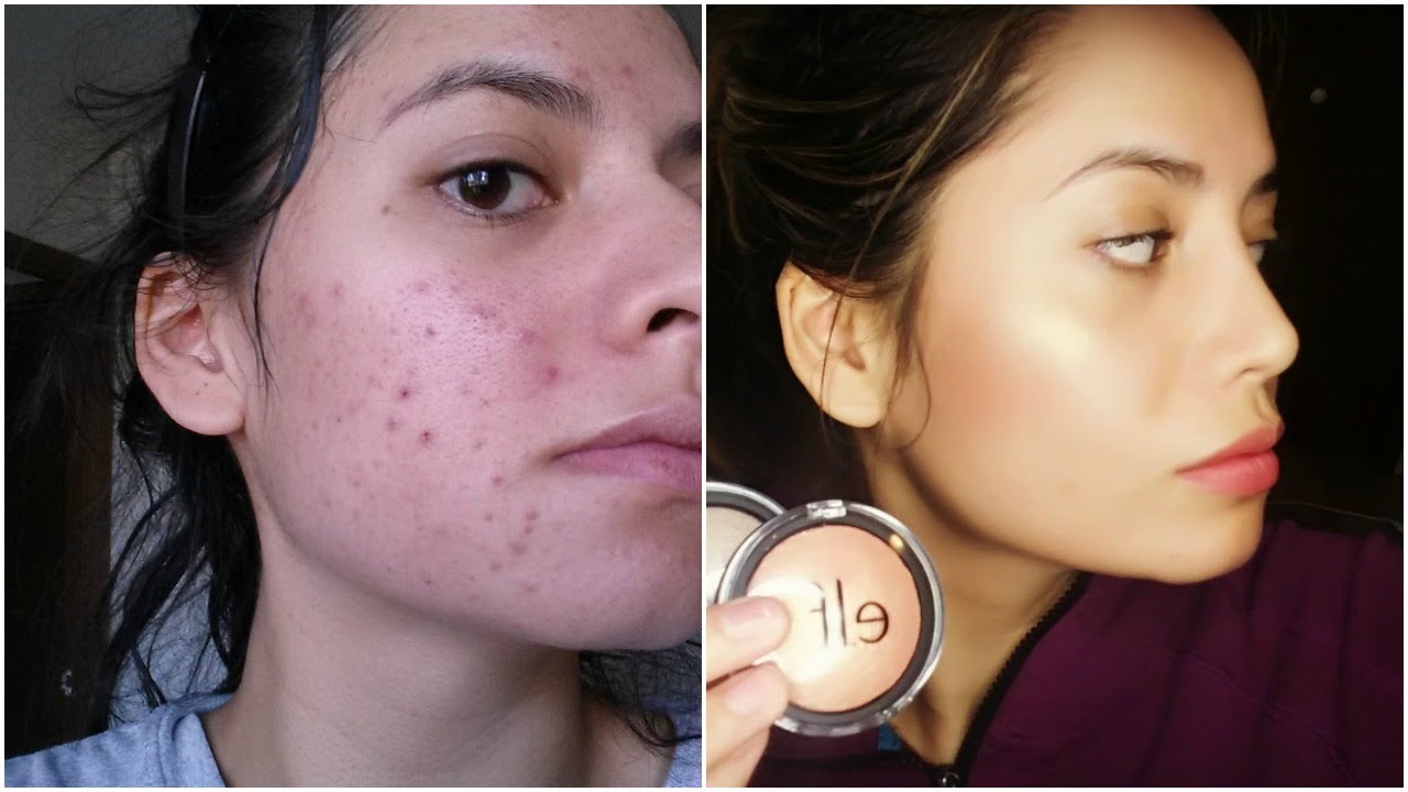 КАК СПРАВИТЬСЯ С «НЕПРИЯТНОЙ ФАЗОЙ» ПРИЕМА РЕТИН-А | СВЯТОЙ ГРААЛЬ СОВЕТОВ!