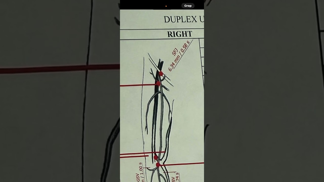 Reflux testing: do you know where and what veins are problematic? What today’s report showed. 