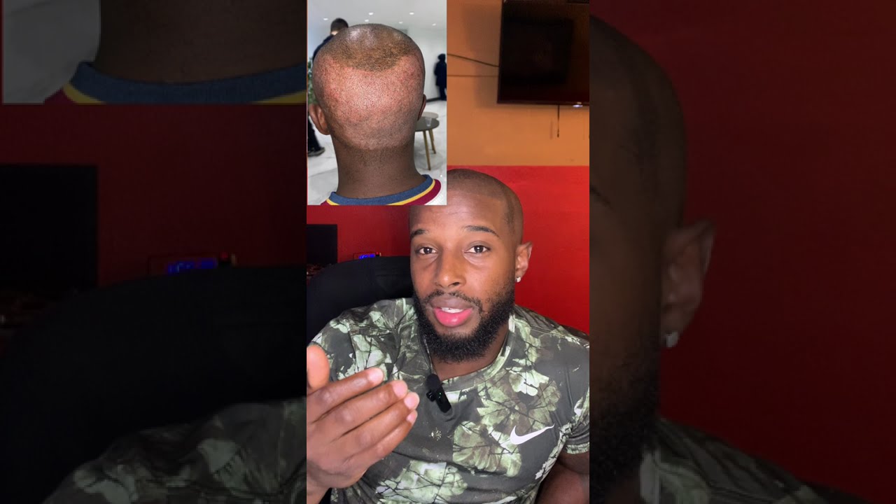 Hair Transplant Journey – 2 Month Update | Real Results, Regrowth & Shedding Phase EPISODE 6