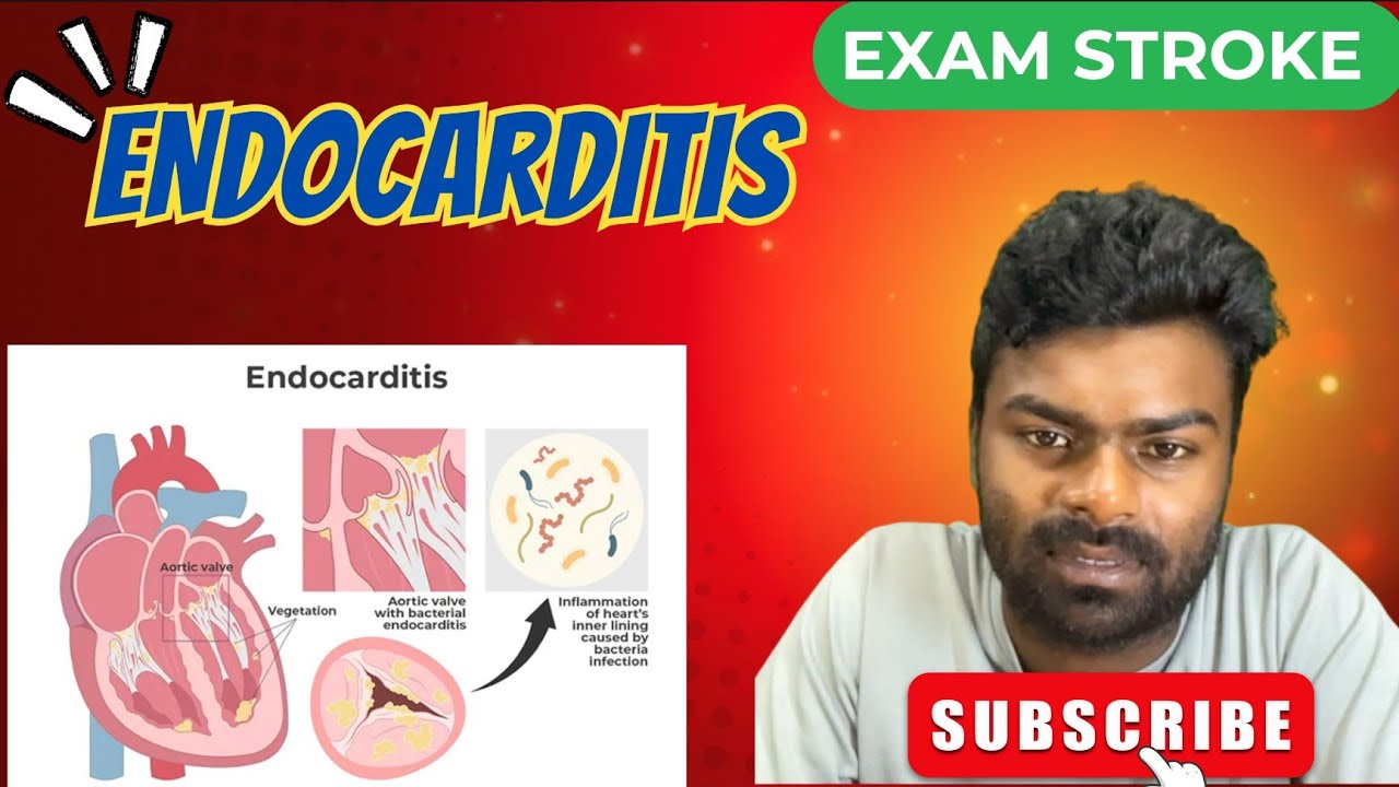 ENDOCARDITIS FULL DETAILS 
