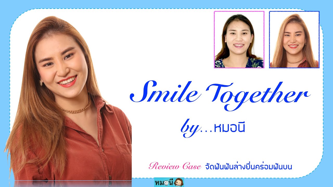 รีวิวจัดฟันเสร็จแล้ว ::น้องมอส ฟันล่างยื่นคร่อมฟันบน