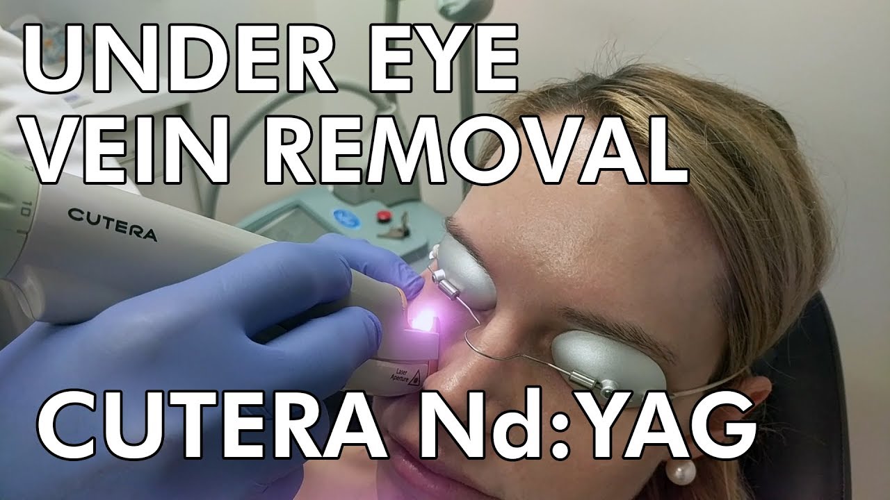 Under Eye Vein Removal: Cutera Nd:YAG Laser - Dr. Paul Ruff | West End Plastic Surgery
