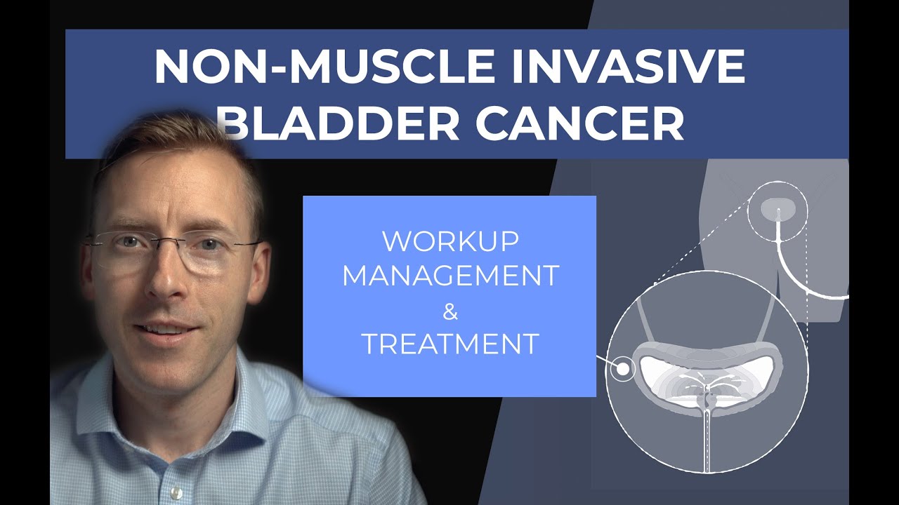 Management of Non-Muscle Invasive Bladder Cancer