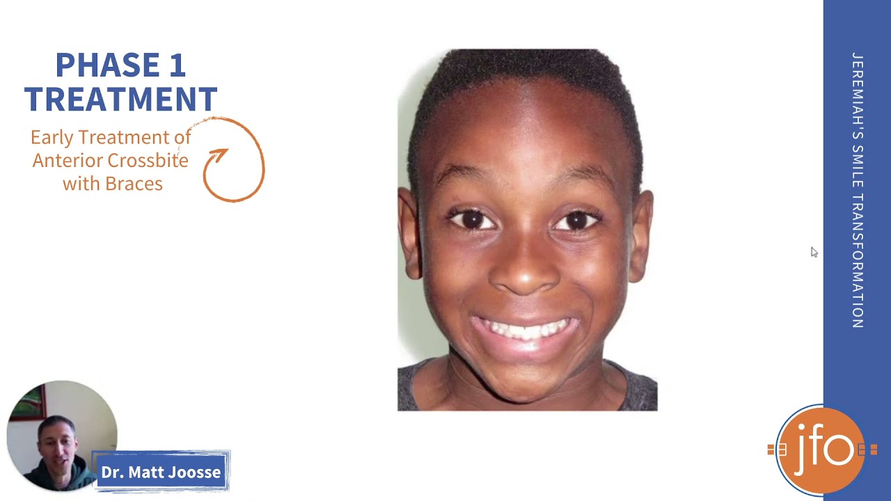 Early Treatment of Anterior Crossbite with Braces | Joosse Family Orthodontics | Williamsburg, VA