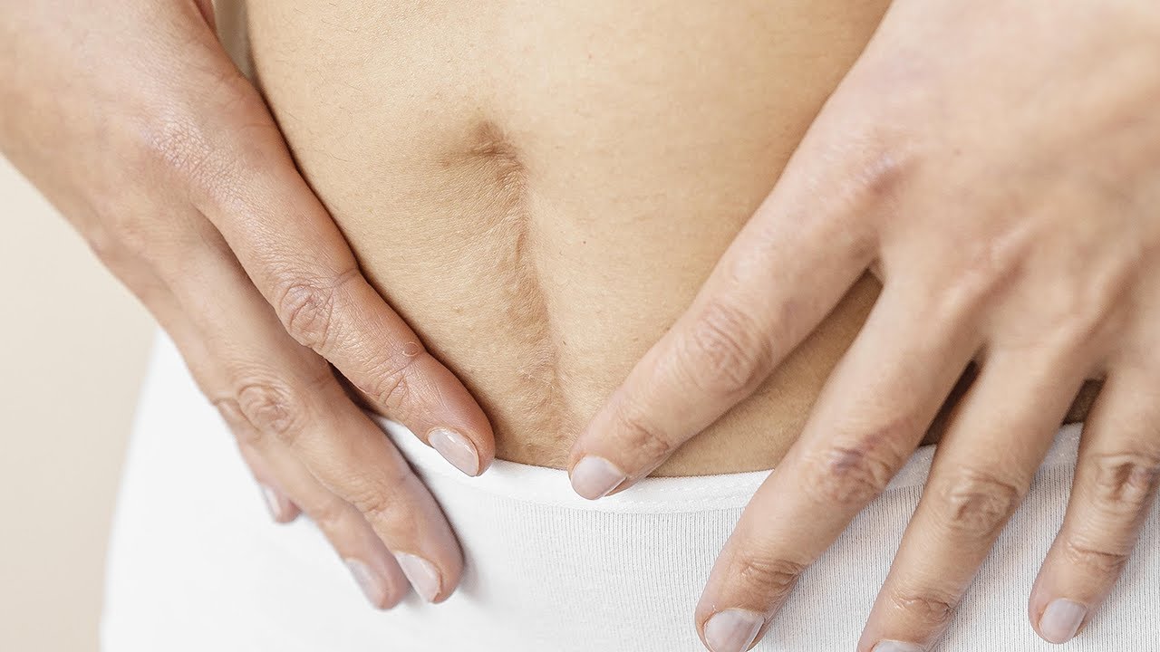 ¿Cicatrices? Descubre sus tipos