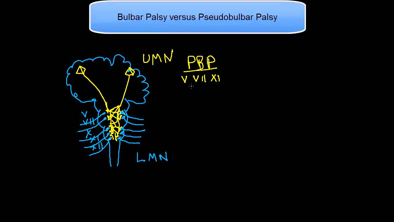 Bulbar Palsy versus Pseudobulbar Palsy