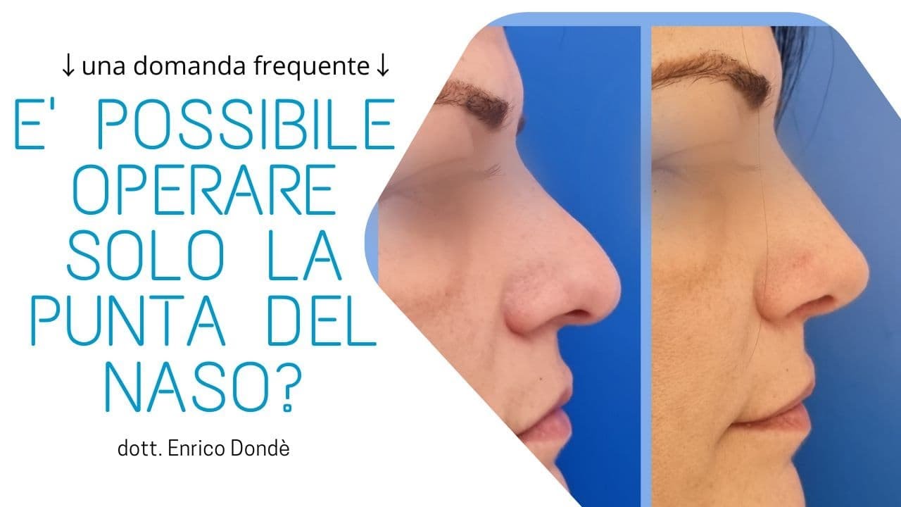 👃 E' possibile operare solo la punta del naso? | dr. Enrico Dondè