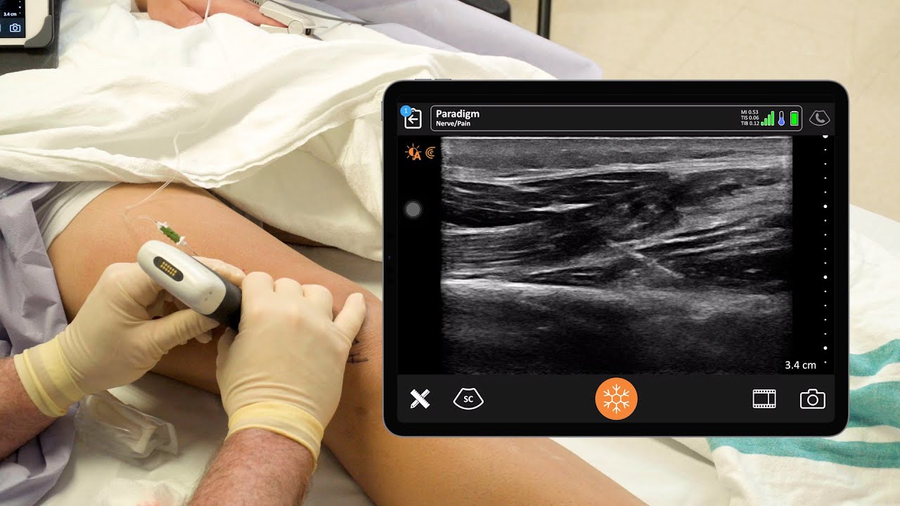 ACL Block #2 - Genicular Nerve