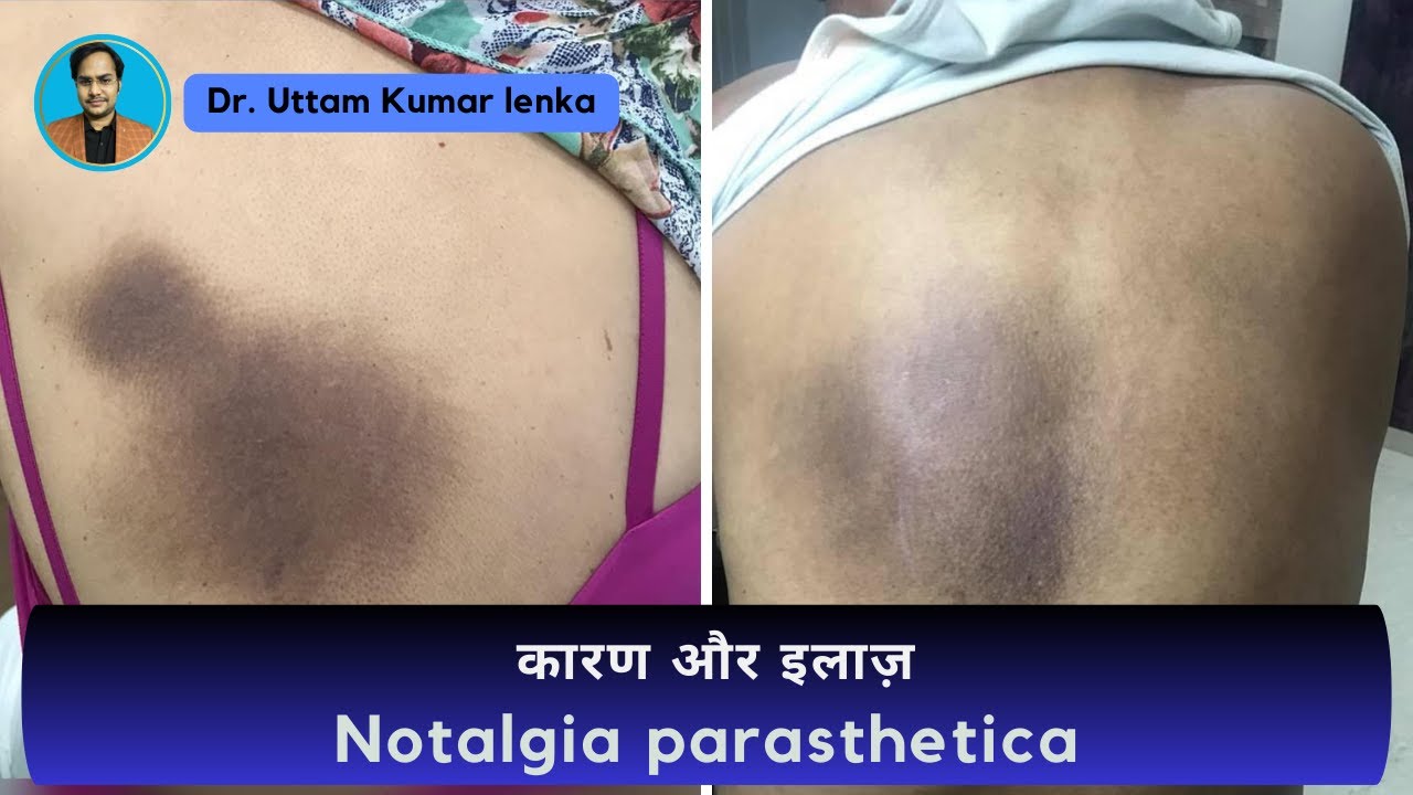 Notalgia parasthetica Tretmant | back itching cause / पीठ में खुजली का इलाज / Dr. Uttam Kumar Lenka