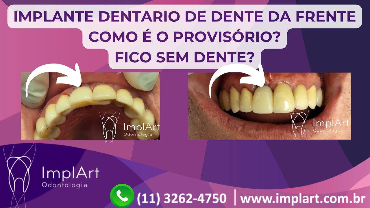 IMPLANTE DENTARIO DENTE DA FRENTE - COMO &Eacute; O PROVIS&Oacute;RIO? FICO SEM DENTE? @clinicaimplart #implante