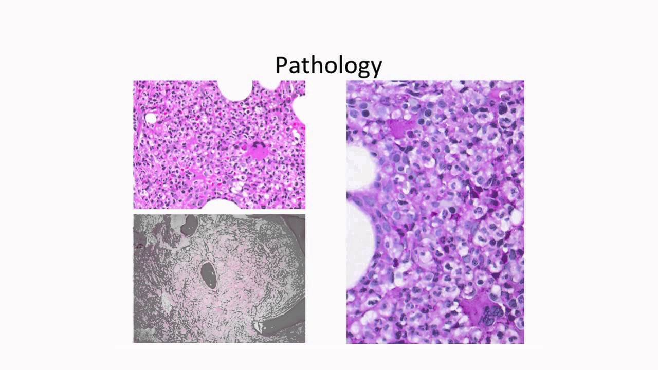 Molecular Profiling of Myelodysplastic Syndromes